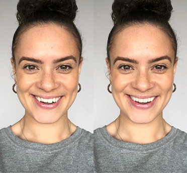 Image by Invisalign®