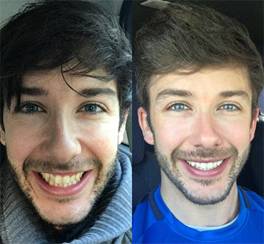 Image by Invisalign®