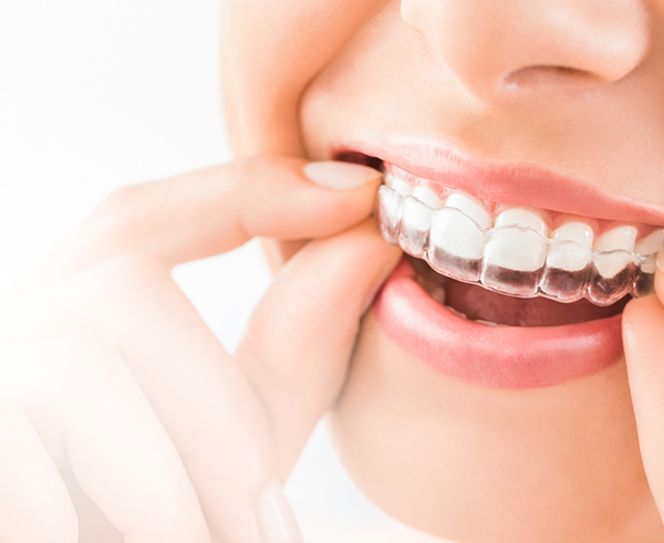 Invisalign®
